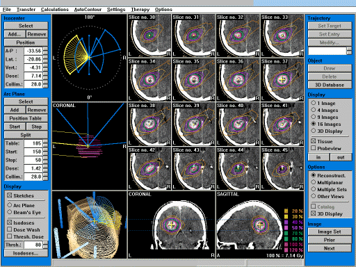 Radiation Planning