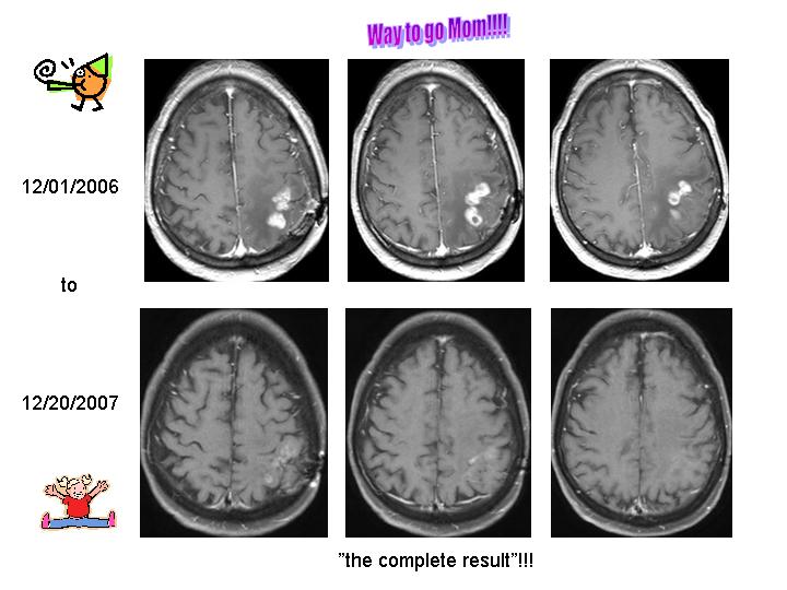 avastin side effects. logo. avastin glioma