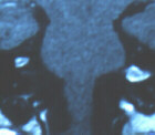 mri image